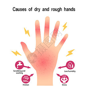 干手和粗手的原因弯手矢量说明过敏摩擦女性润肤保健男人身体湿疹卫生皮肤科图片