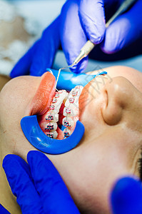 使用牙科钻牙术进行牙科手术的女病人手套牙钻牙齿卫生成人诊所临床诊断内科访问图片