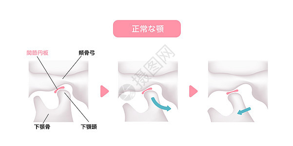 开启和特写下巴时的结构插图Name关节盘渲染外科牙科骨头障碍骨骼矫正生物学机能图片