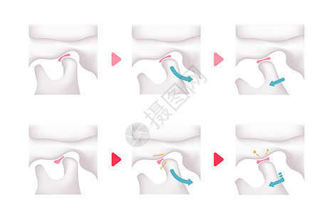 正常下巴和疾病TMD比较图科学手术外科矫正机能关节盘颅骨解剖学骨头渲染图片