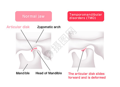 比较动脉磁盘形状正常下巴和坦波罗曼二脑紊乱的说明疾病渲染插图骨骼关节盘外科骨头矫正牙齿颅骨图片