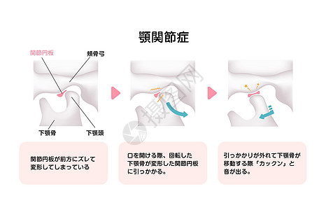 关于临时脑二膜紊乱原因的说明TMD身体骨头解剖学渲染机能生物学牙齿障碍插图疾病图片