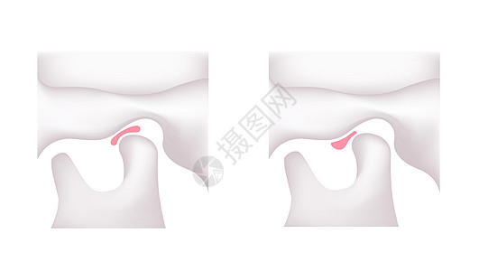 比较动脉磁盘形状正常下巴和坦波罗曼二脑紊乱的说明关节身体矫正外科骨骼障碍下颌颅骨生物学疾病图片