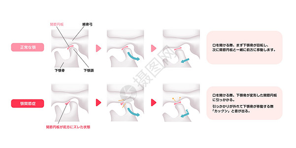 正常下巴和疾病TMD比较图关节盘下颌解剖学牙科骨头手术成形术药品机能骨骼图片