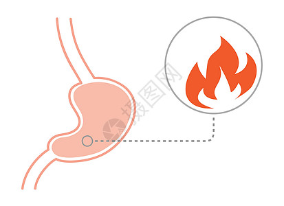 人胃着火 切开视图 以平式方式进行矢量插图图片
