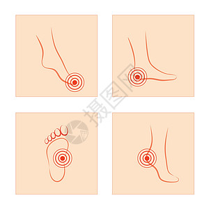 保健概念的简单设计 即身体部位疼痛和受伤妇女在脚 脚踝和脚趾感到疼痛药品肌肉风湿女士脚印伤害脚跟神经插图痛苦图片