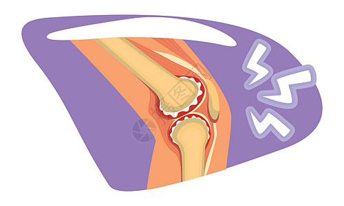 Knee 疼痛 2D 矢量孤立插图图片