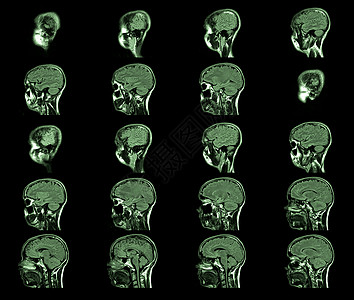 磁共振成像 MRI MRT头图片