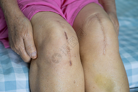 亚洲老年或老年老太太妇女病人在护理医院病房的床上展示她的疤痕手术全膝关节置换缝合伤口手术关节成形术 健康强大的医疗理念瘢痕愈合皮图片