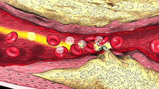 显微摄影显示含有胆固醇的凝固性醇斑块插图生物解剖学细胞化学人体血流红细胞损害生理图片