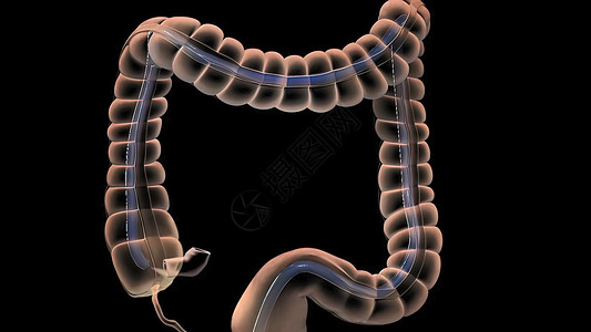 人类消化系统 3D 结肠镜检查程序插图外科动画诊断器官监视器乐器药品结肠炎预防检测图片