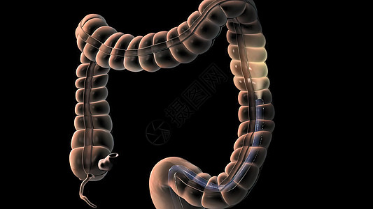 人类消化系统 3D 结肠镜检查程序插图讨论预防检查测试内窥镜手术大肠乐器疾病器官图片
