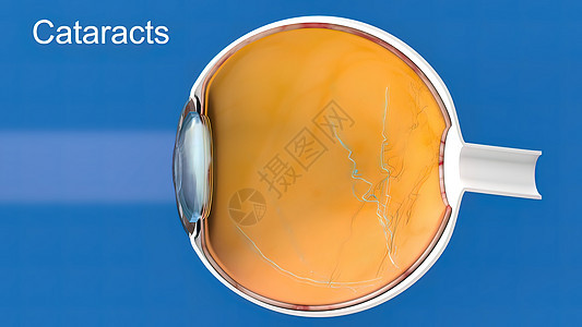 白内障 蒙上眼睛的透镜 导致视力下降眼球显微镜折射手术乳化解剖学外科胶囊病人医院图片