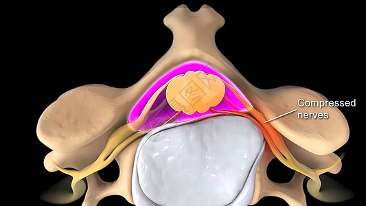 破碎变形的盘片 对神经施压生物学身体颈椎病胸椎外科韧带整脊循环脊柱光盘图片