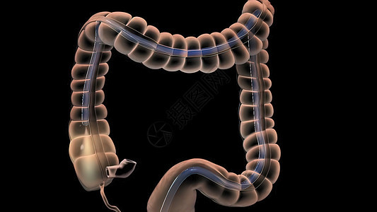 人类消化系统 3D 结肠镜检查程序插图息肉检查大肠药品结肠炎乐器监视器动画外科预防背景图片