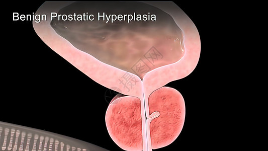 3d医用3d医学状况尿道痛苦解剖学尿流膀胱男性组织男士尿液图片