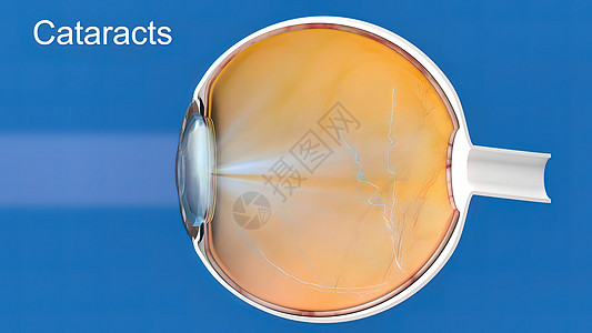 白内障 蒙上眼睛的透镜 导致视力下降外科横截面显微镜疾病眼科诊所医生瞳孔手术角膜图片