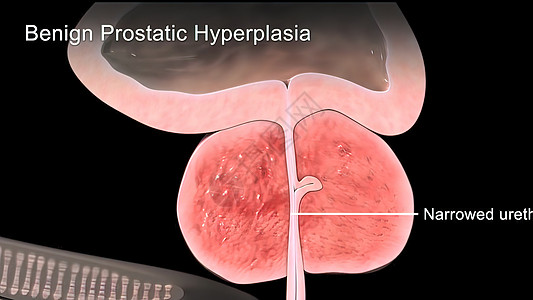 3d医用3d医学男士尿频男性前列腺组织疾病痛苦健康状况生殖系统图片