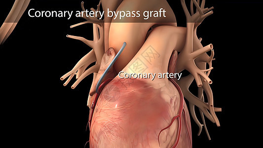 冠动脉绕行手术使用一个健康血液容器进行 叫做移植镊子医师外科夹钳钳子专家心血管手套嫁接心脏病图片