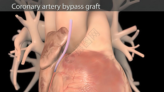 冠动脉绕行手术使用一个健康血液容器进行 叫做移植仪器镊子夹钳医师循环主动脉外科手术室手术伤口图片