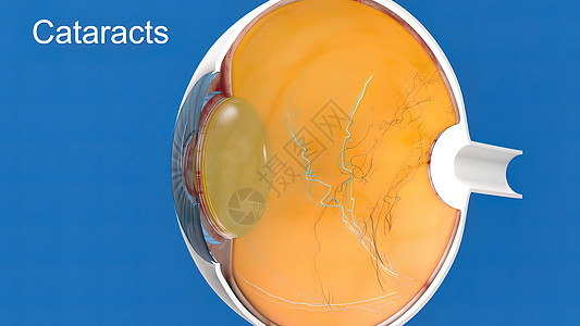 视力不佳白内障 蒙上眼睛的透镜 导致视力下降治疗技术超声横截面医生透明度诊所显微镜巩膜外科背景