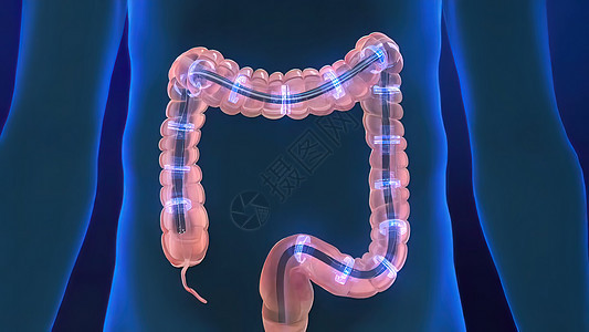 人类消化系统 3D 结肠镜检查程序插图检查器官息肉药品大肠乐器冒号外科手术消化背景图片