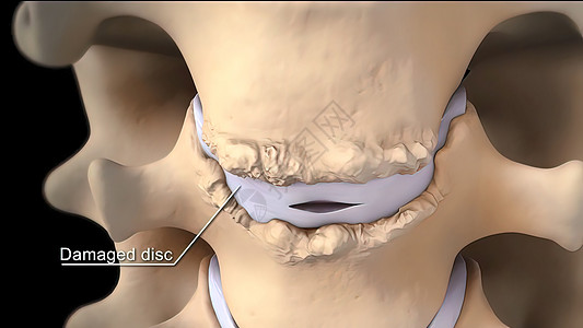 拆除被损坏的盘片 代之以金属盘片韧带生物学手术静脉整脊神经脖子系统脊柱疼痛图片