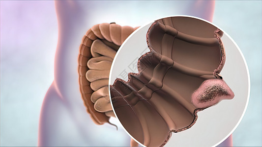 肠癌放大镜肿瘤的形成和发育 a 癌症大肠监视器插图剪辑检测乐器消化测试药品相机背景图片