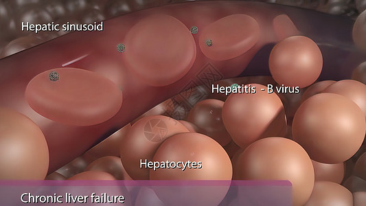 B型肝炎病毒造成的慢性肝衰竭手术解剖学脂肪酸疾病胆囊信息身体细胞肝病器官图片