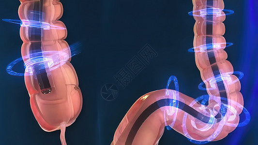 人类消化系统 3D 结肠镜检查程序插图诊断器官监视器息肉动画药品结肠炎解剖学乐器讨论图片