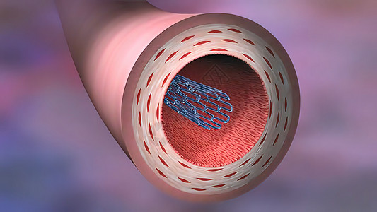 血管成像一词的意思是用气球拉开一个较窄的药品封锁干涉支架牌匾阀门心脏病学导管动脉药物图片