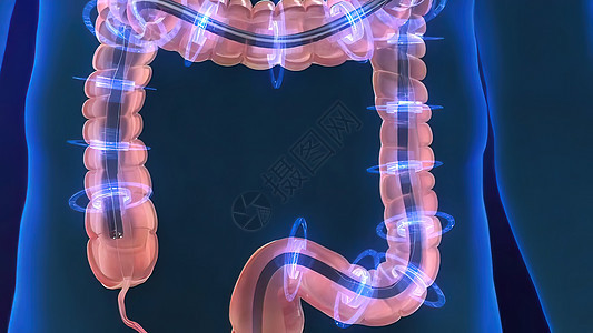 人类消化系统 3D 结肠镜检查程序插图诊断测试病理预防手术内窥镜冒号外科解剖学结肠炎图片