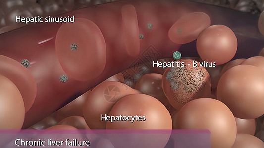 B型肝炎病毒造成的慢性肝衰竭肝炎手术外科男性图表药品胆囊器官黄疸疼痛图片