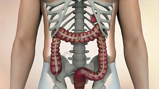 在肠道或肠道癌肿瘤可见的肠透镜检查中 结肠结肠癌男人直肠病理医生消化生物学保健细胞身体疼痛图片