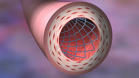 血管成像一词的意思是用气球拉开一个较窄的导管癌症程序身体支架药物外科蓝色关心干涉图片