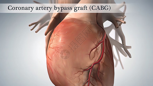 冠动脉绕行手术使用一个健康血液容器进行 叫做移植器械外科药品主动脉动脉动脉硬化钳子手套循环专家图片