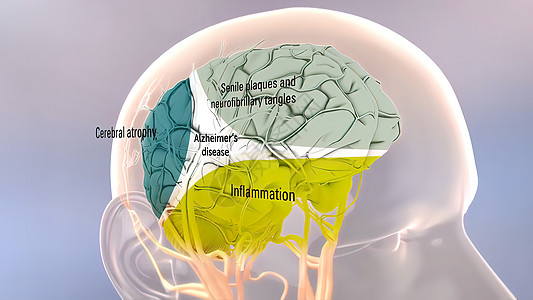 Amyloid 前体蛋白质剂加工和阿尔茨海默氏病神经元疾病牌匾插图纤维手术生物3d衰老精神图片