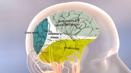 Amyloid 前体蛋白质剂加工和阿尔茨海默氏病神经元外科老化斑块癌症牌匾健康失智衰老动画图片