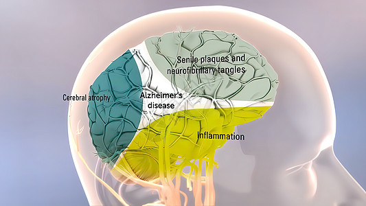 Amyloid 前体蛋白质剂加工和阿尔茨海默氏病动画生物疾病纤维健康神经元外科失智药品细胞图片