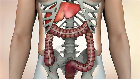 在肠道或肠道癌肿瘤可见的肠透镜检查中 结肠结肠癌研究疼痛手术治疗附录冒号卫生消化解剖学药品图片
