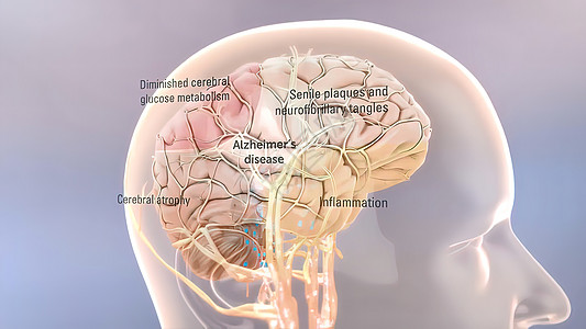 Amyloid 前体蛋白质剂加工和阿尔茨海默氏病3d癌症生物艺术品插图牌匾手术药品失智疾病图片