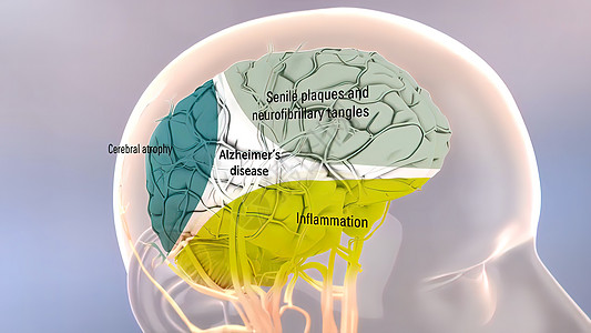 斗图动画素材Amyloid 前体蛋白质剂加工和阿尔茨海默氏病老化多肽艺术品癌症失智生物牌匾健康神经元插图背景