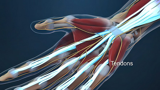 腕管综合症是指正中神经在穿过腕管时受压手指诊断疼痛外科手臂隧道解剖学身体手术痛苦图片