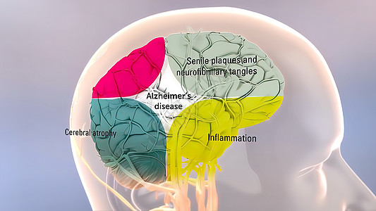 Amyloid 前体蛋白质剂加工和阿尔茨海默氏病衰老动画健康疾病癌症生物3d斑块老化精神图片