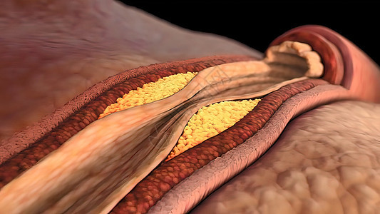 冠状动脉抽搐是这些动脉之一的短暂 突然缩小压力医学细胞血块攻击危险凝块动脉粥样硬化血管疾病背景图片