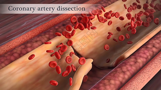 冠状动脉抽搐是这些动脉之一的短暂 突然缩小攻击危险动脉硬化营养牌匾心脏病学凝块医学心血管压力图片