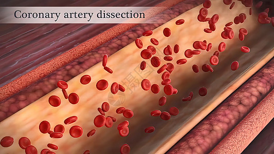 冠状动脉抽搐是这些动脉之一的短暂 突然缩小油炸凝块动脉硬化中风科学攻击营养肥胖药品细胞图片