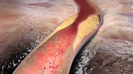 将动脉与石碑连在一起牌匾科学血块细胞心脏病学动脉粥样硬化药品疾病营养医学图片