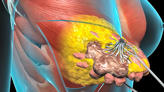 心脏肿瘤生长的外科手术乳腺医生身体插图腺体艺术品科学女性化疗水晶背景图片