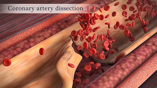 冠状动脉抽搐是这些动脉之一的短暂 突然缩小医学封锁动脉硬化牌匾血块心脏病学血管油炸细胞中风图片